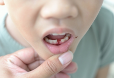Help! My Child Fell And Lost a Permanent Tooth!