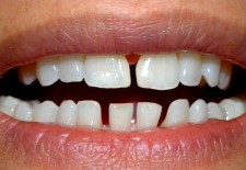 Question: Why Are Some Spaces Between Teeth Larger Than Others?