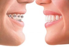 What Is An Overbite?
