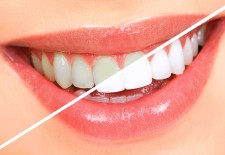 How Do Whitening Toothpastes Work?