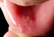 What Are Canker Sores?