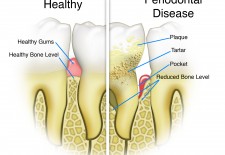 Gum Disease Risk Quiz: Are You At Risk?
