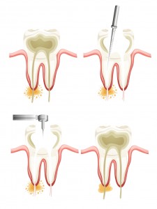 What To Expect During A Root Canal