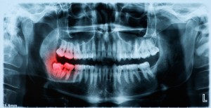What Are Wisdom Teeth, And Why Do We Have Them?
