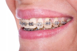 woman with teeth braces