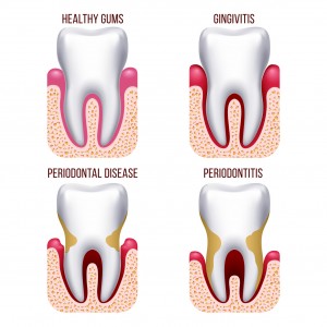 Gingivitis and periodontal, periodontitis illustration