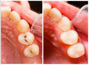 Teeth before and after treatment with dental composite filling