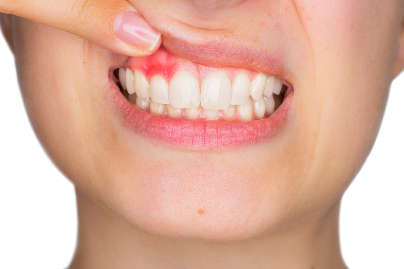 Recognizing and Treating Dental Abscesses
