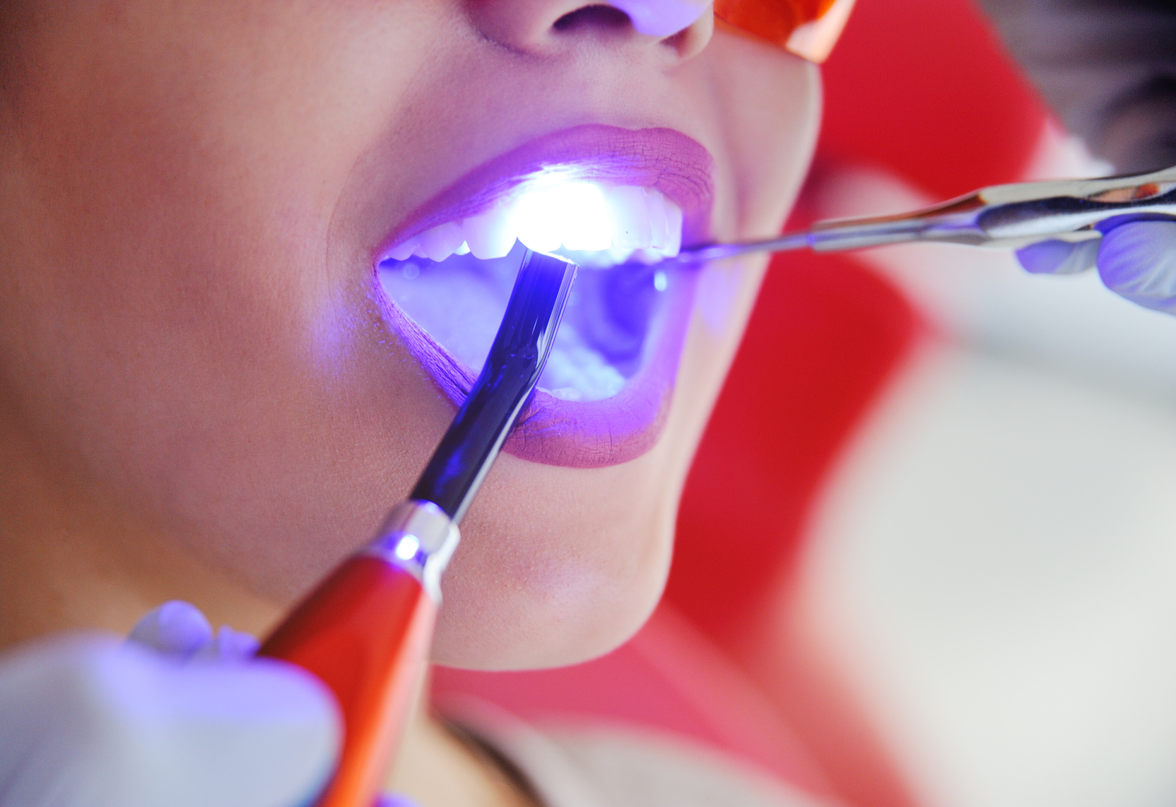 How ‘Long in the Tooth’ Can a Tooth Filling Get?